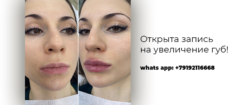 Увеличение губ в Курске Увеличение губ в Курске